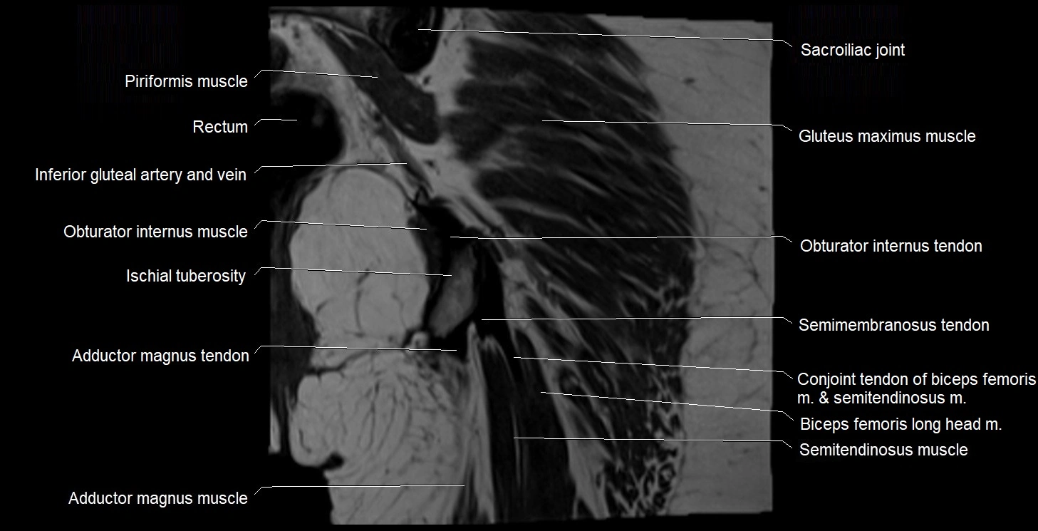MRI Hip 3T coronal cross sectional anatomy image 54.webp